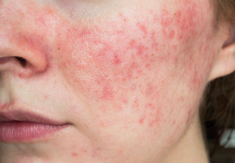 What Is the Best Treatment for Rosacea?