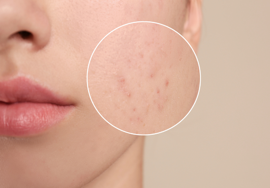 How to effectively combat acne and enlarged pores?