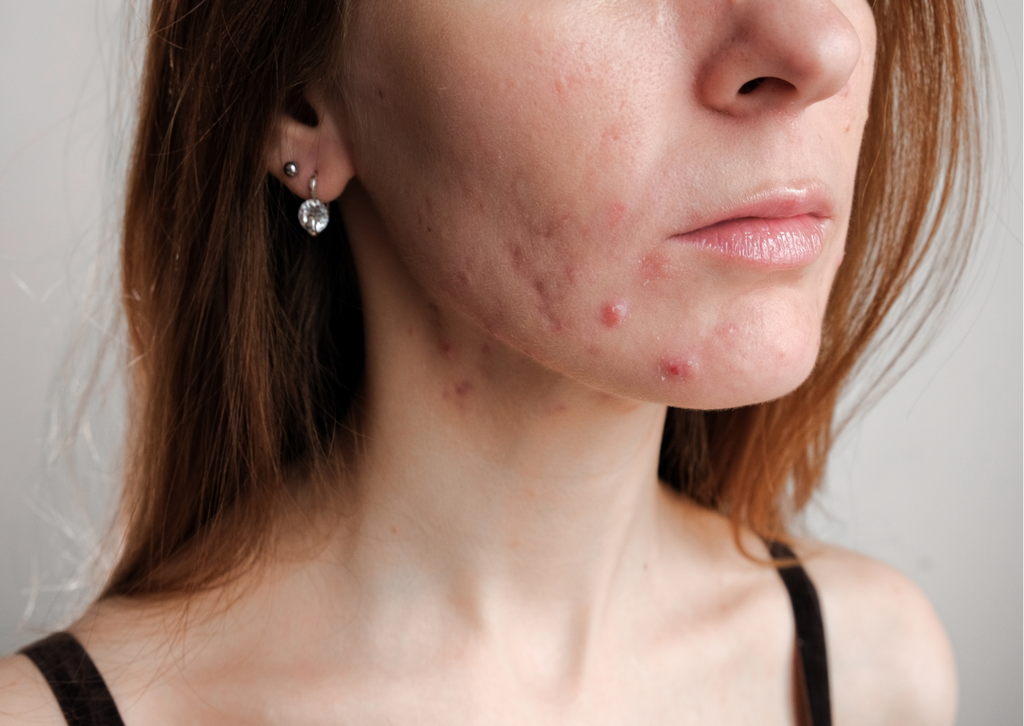 Acne and Blemish-prone Skin